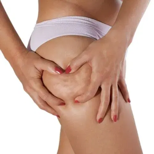 Cellulite