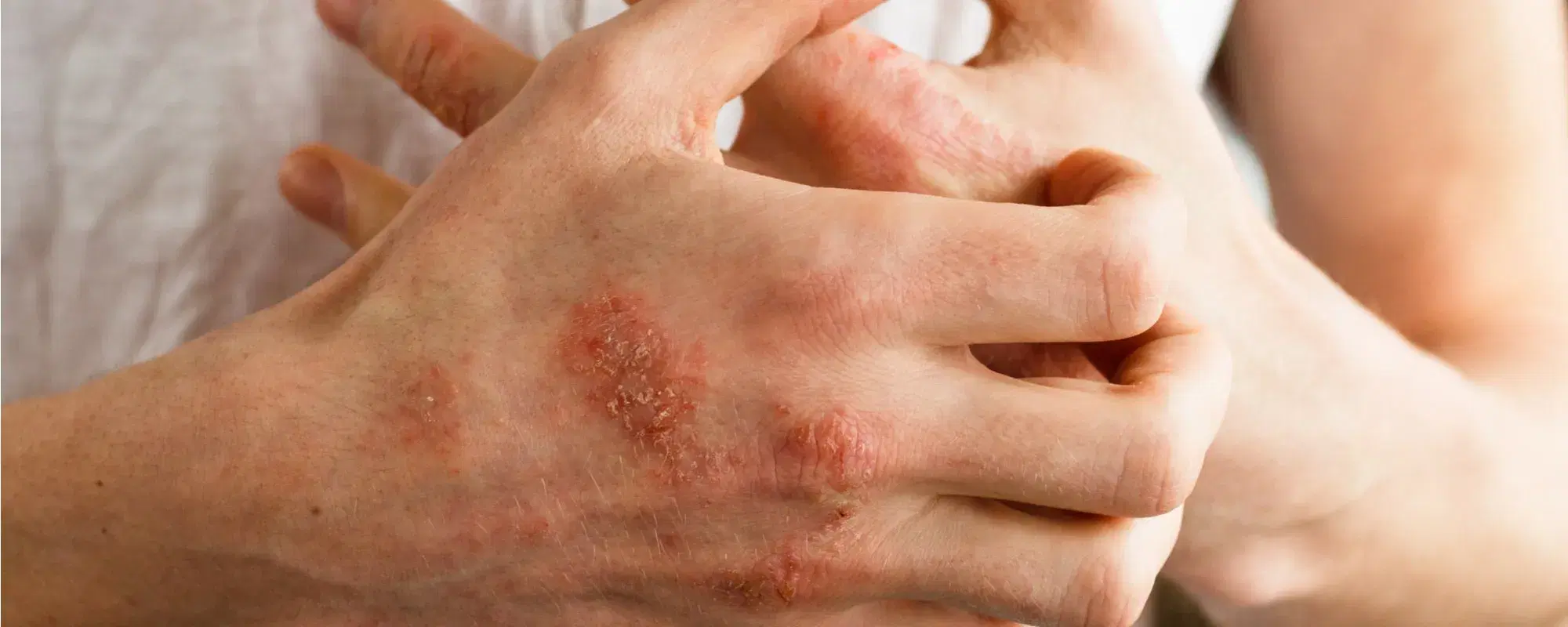 Dermatite atopica