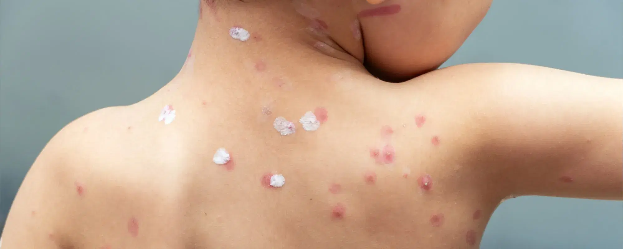 Varicella