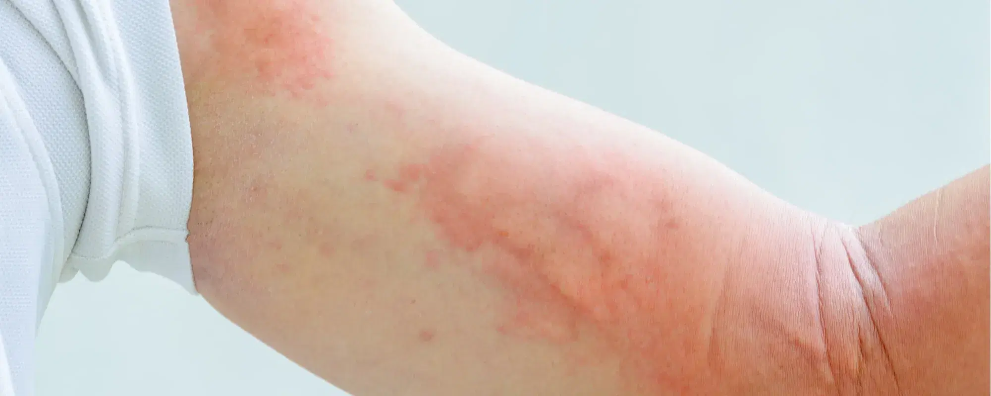 Orticaria solare