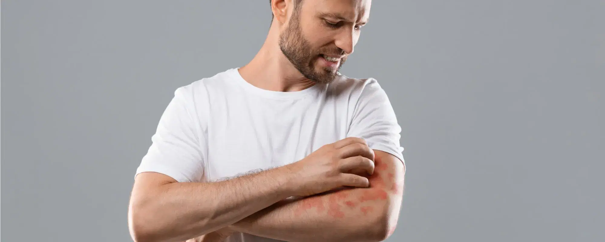 Eczema