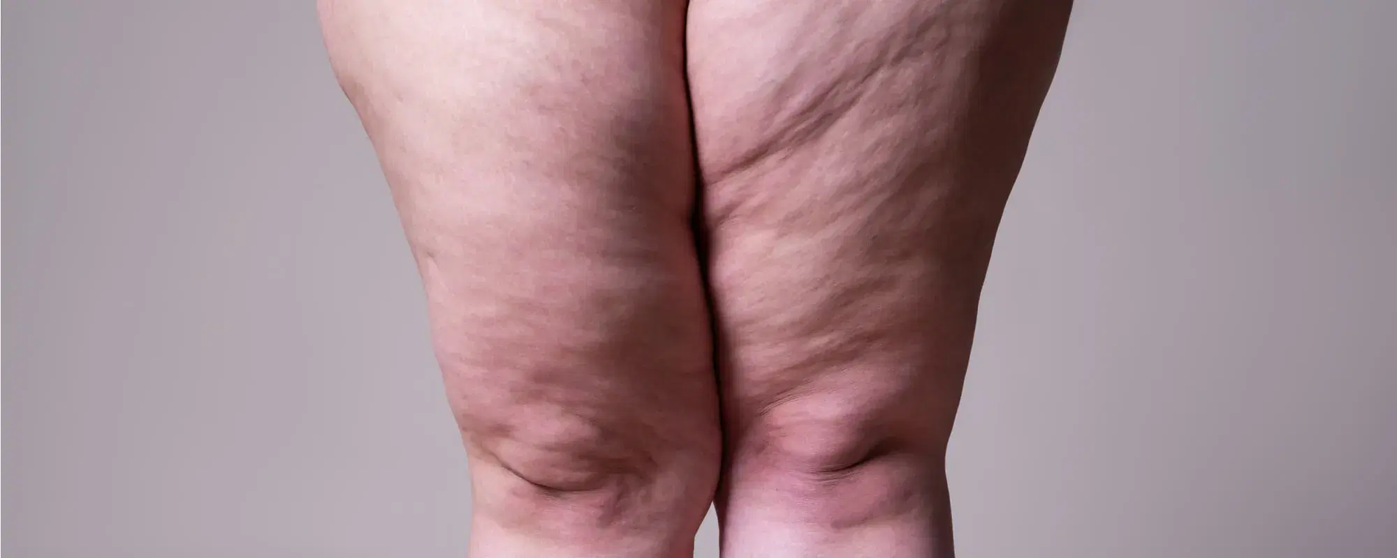 Lipedema