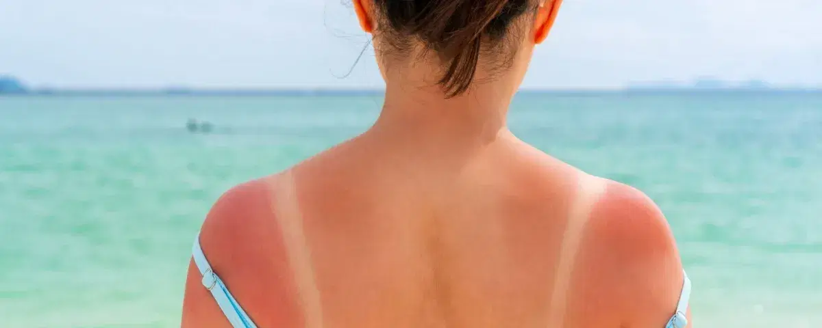 SOS dermatite solare? Cure e trattamenti efficaci per adulti e bambini