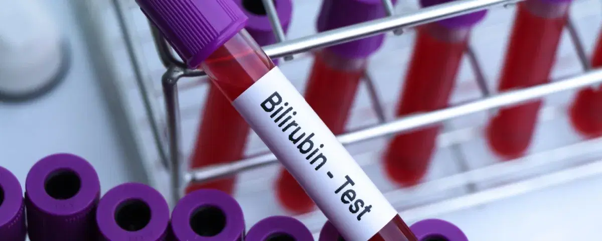 Bilirubina alta: quando preoccuparsi e cosa fare per abbassarla