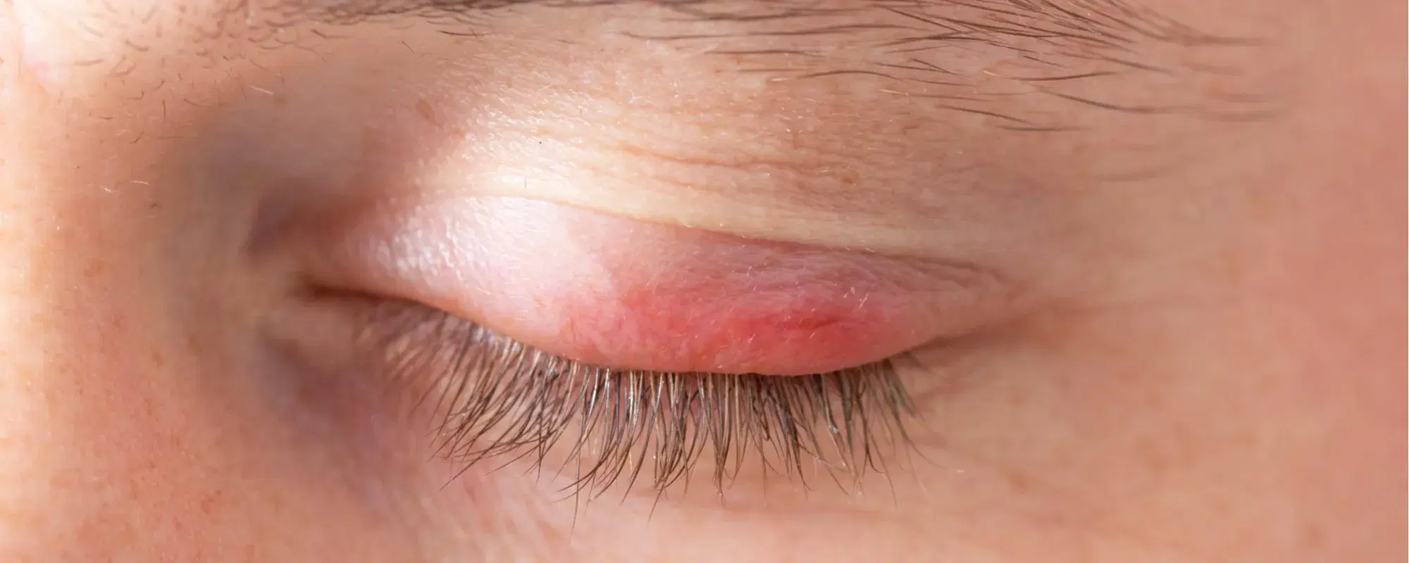 Dermatite palpebrale