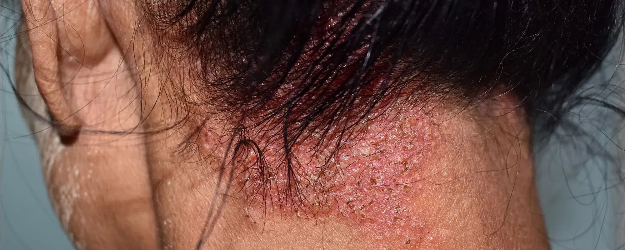 Dermatite seborroica