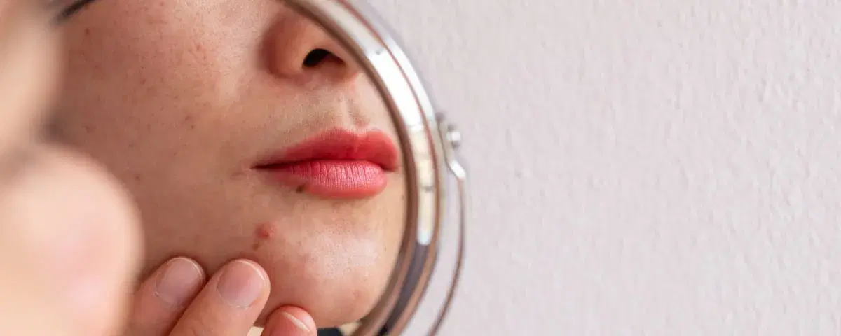Acne ormonale: come riconoscerla e quali prodotti usare per curarla