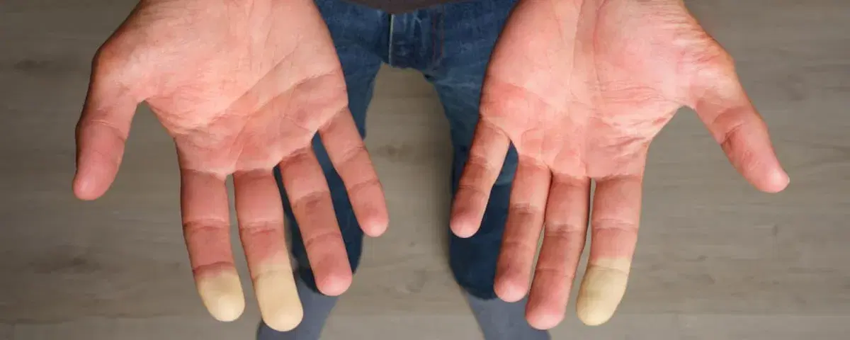Sindrome di Raynaud