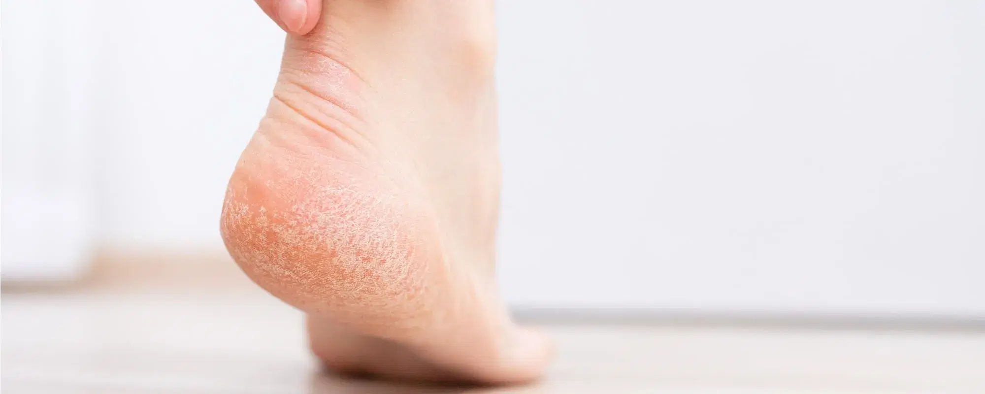 Talloni screpolati in estate? Ecco creme e rimedi della nonna