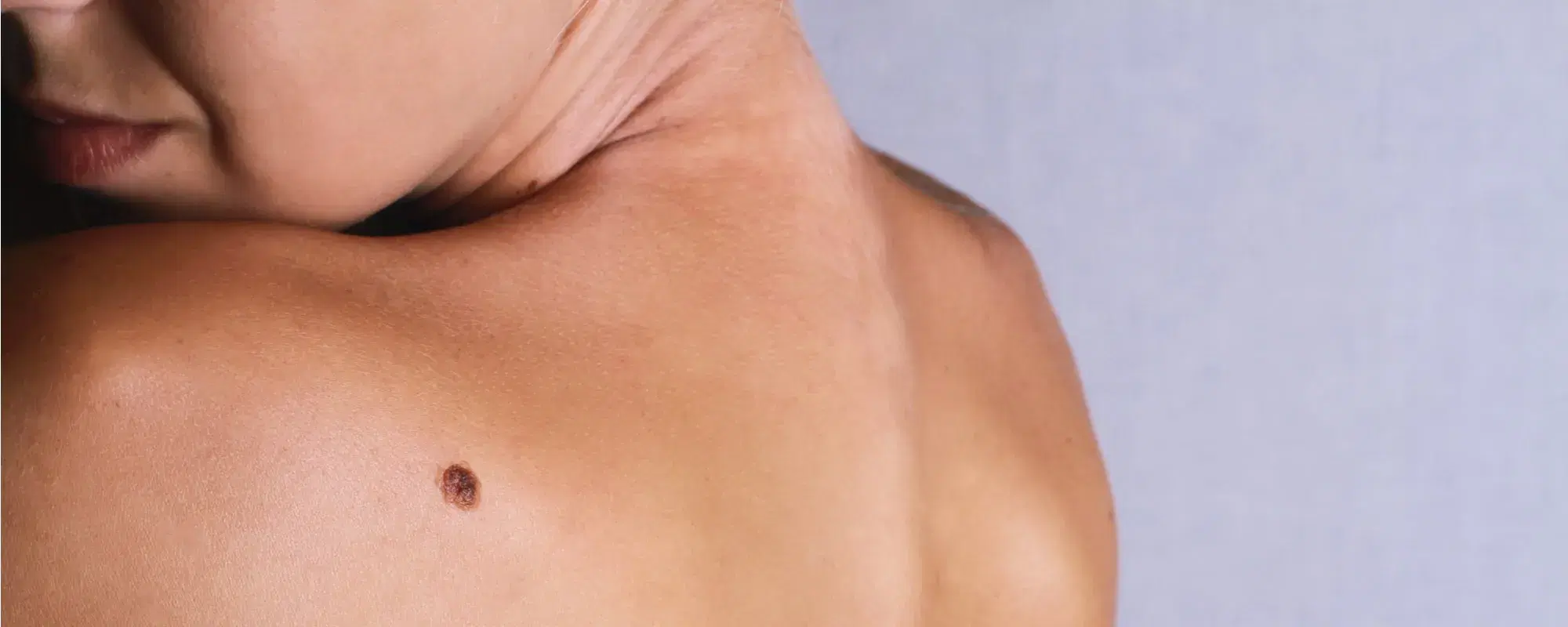 Melanoma cutaneo: ecco come proteggere i nei dal sole