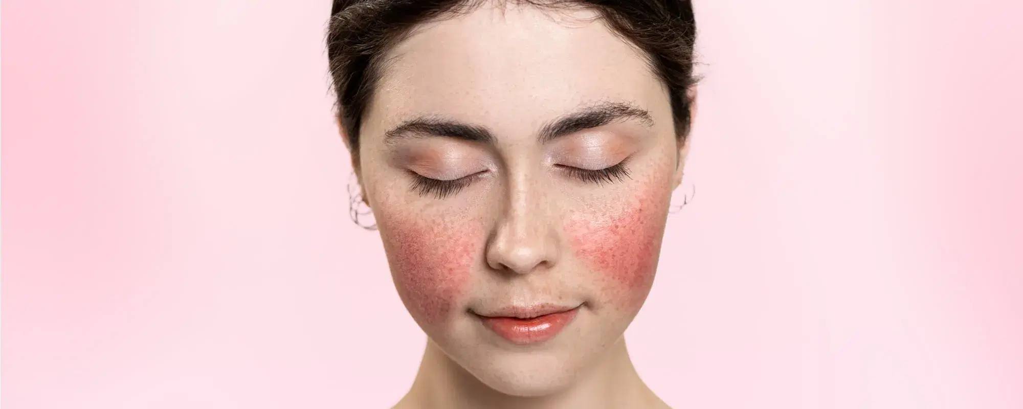 Rosacea