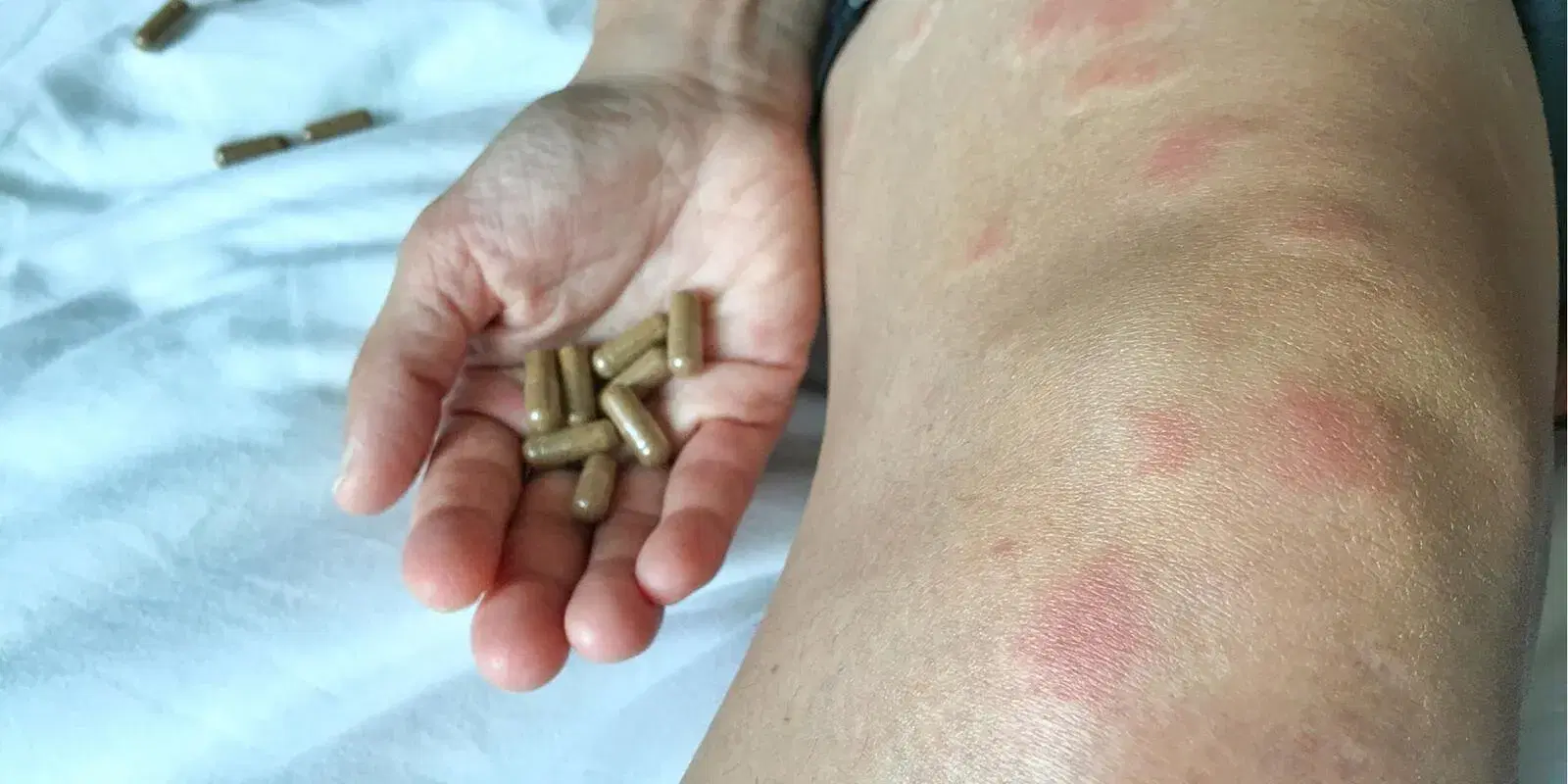 Lupus eritematoso sistemico