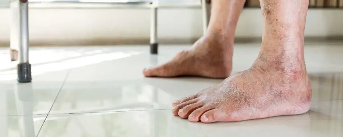 Piede diabetico