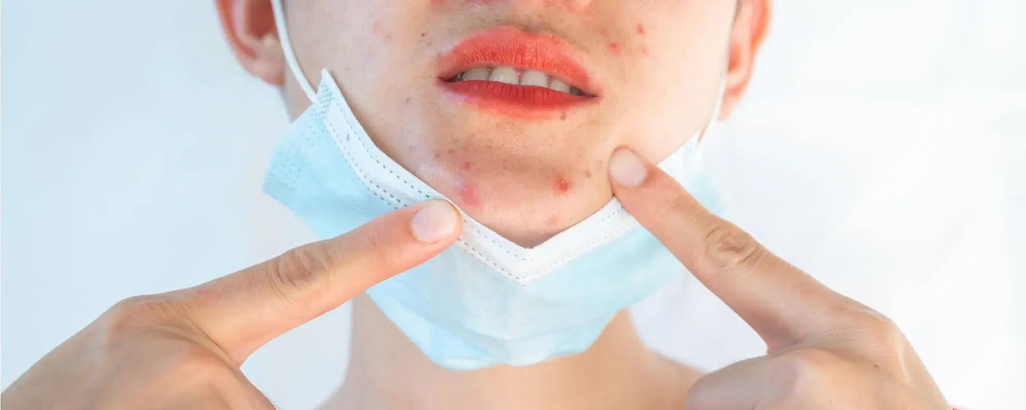 Acne da mascherina: i rimedi per l'effetto maskne