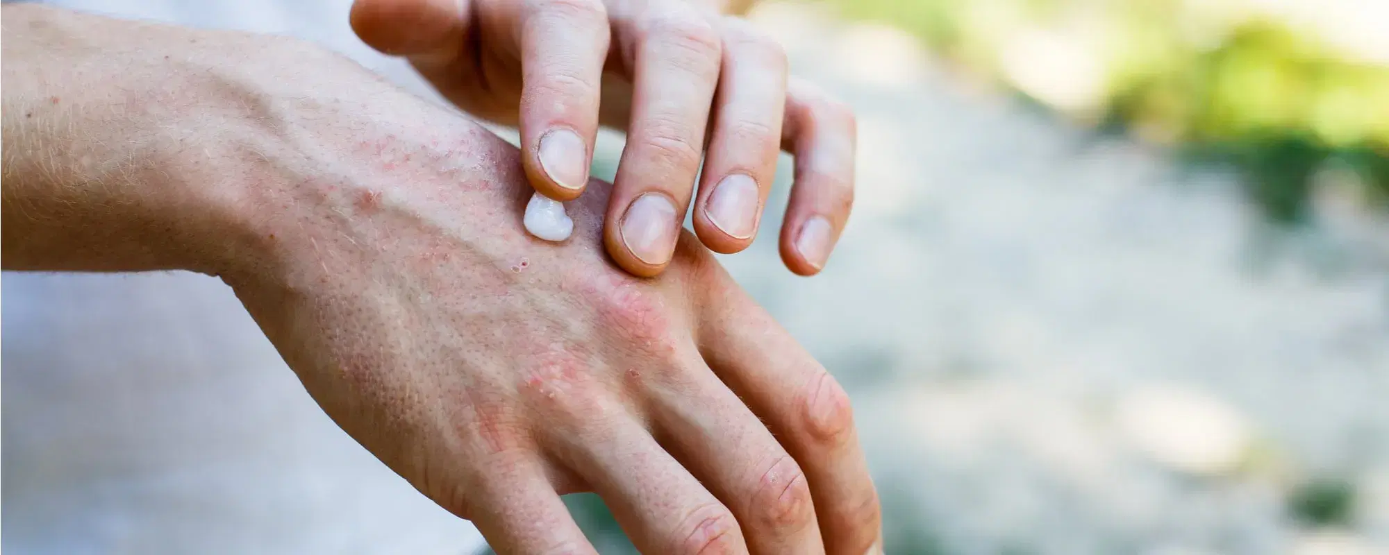 Psoriasi