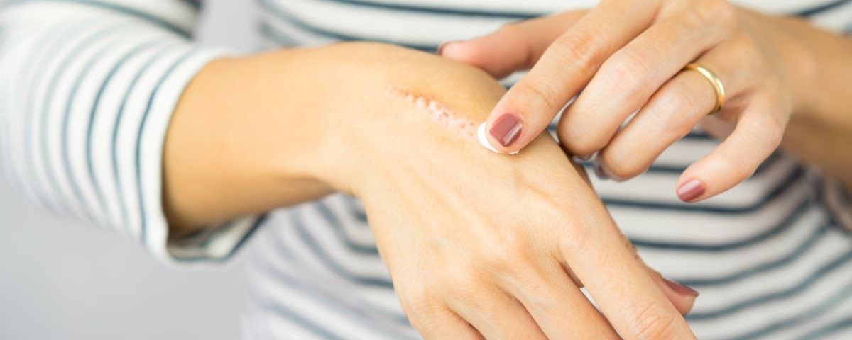 Come prendere il sole sulle cicatrici: 6 consigli per proteggerle